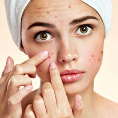 Yoga therapy for Acne & Pimples