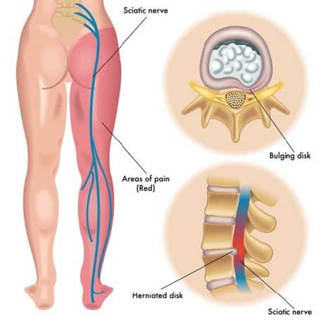 Yoga therapy for Sciatica