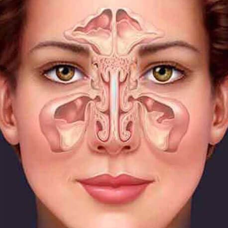 Yoga therapy for Sinusitis