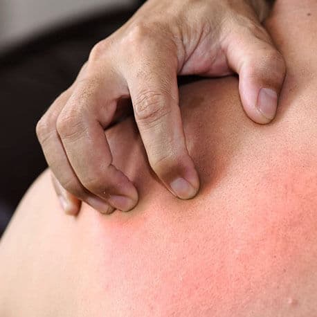 Yoga therapy for Skin Problems